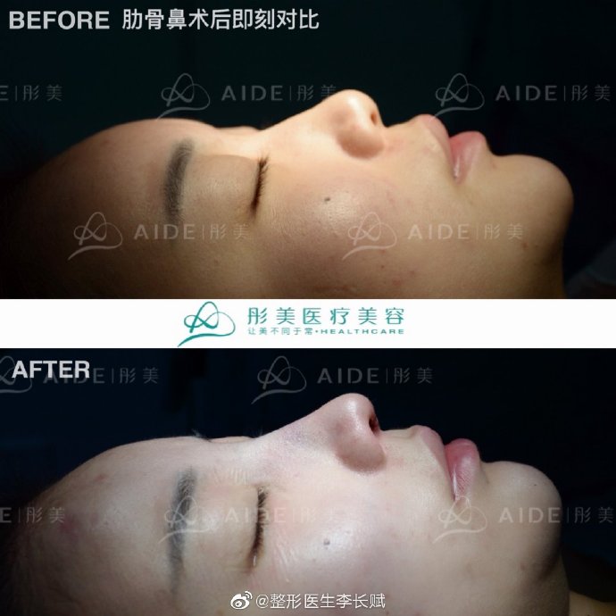 李長賦鼻綜合案例