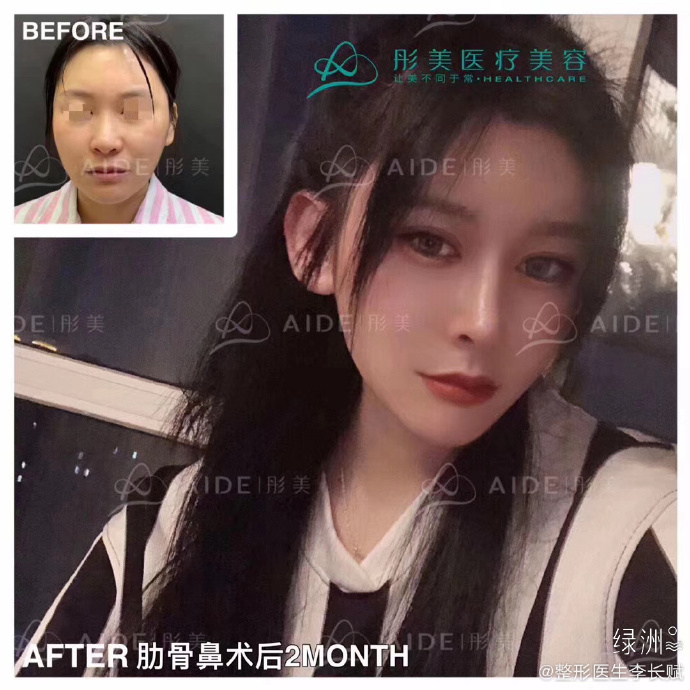 李長賦鼻綜合案例