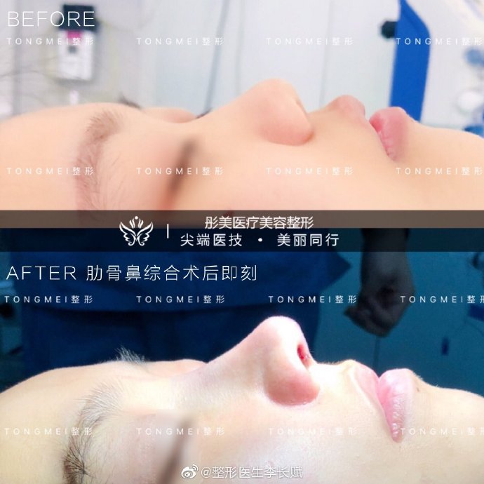 李長賦鼻綜合案例