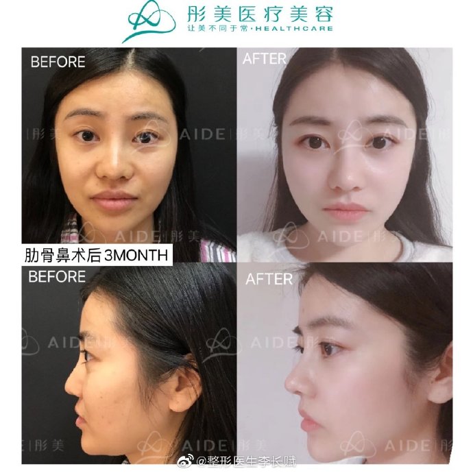 李長賦鼻綜合案例