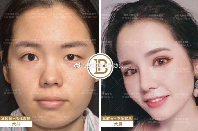 李勁良鼻綜合案例