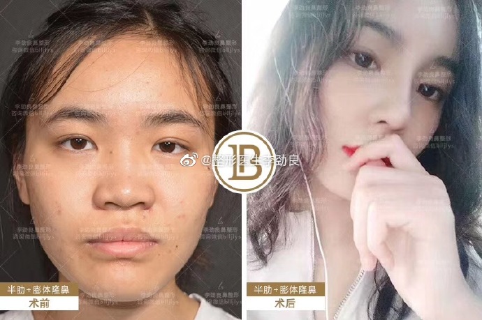 李勁良鼻綜合案例