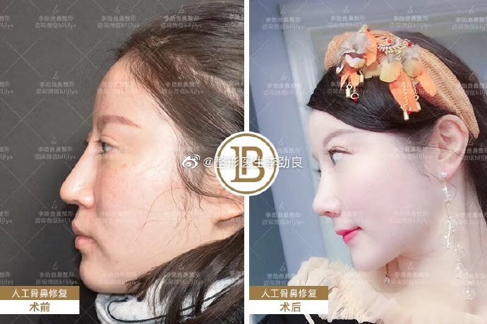 李勁良鼻修復案例