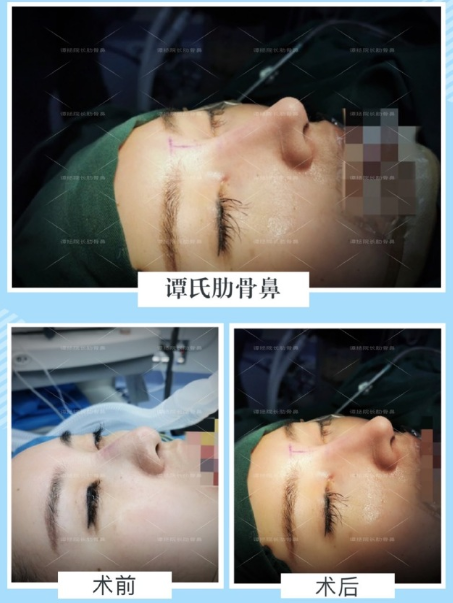譚拯醫生怎么樣？譚拯做鼻子好不好？