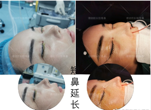 譚拯醫生怎么樣？譚拯做鼻子好不好？