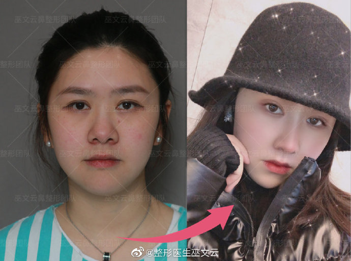巫文云鼻修復案例