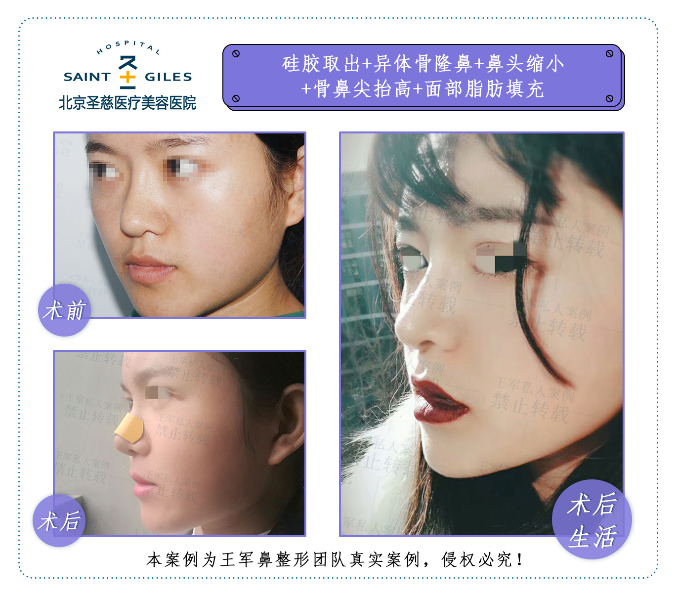 王軍鼻修復案例