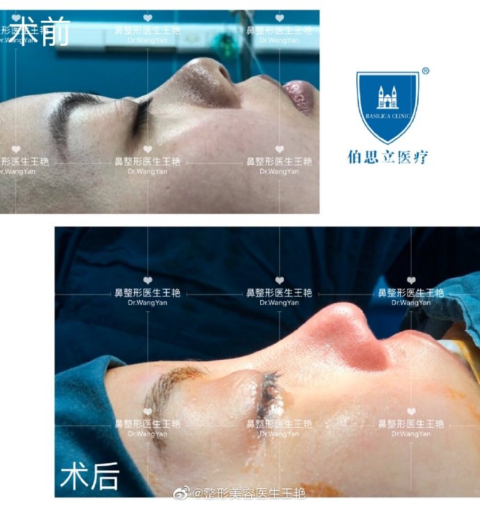 王艷鼻修復案例