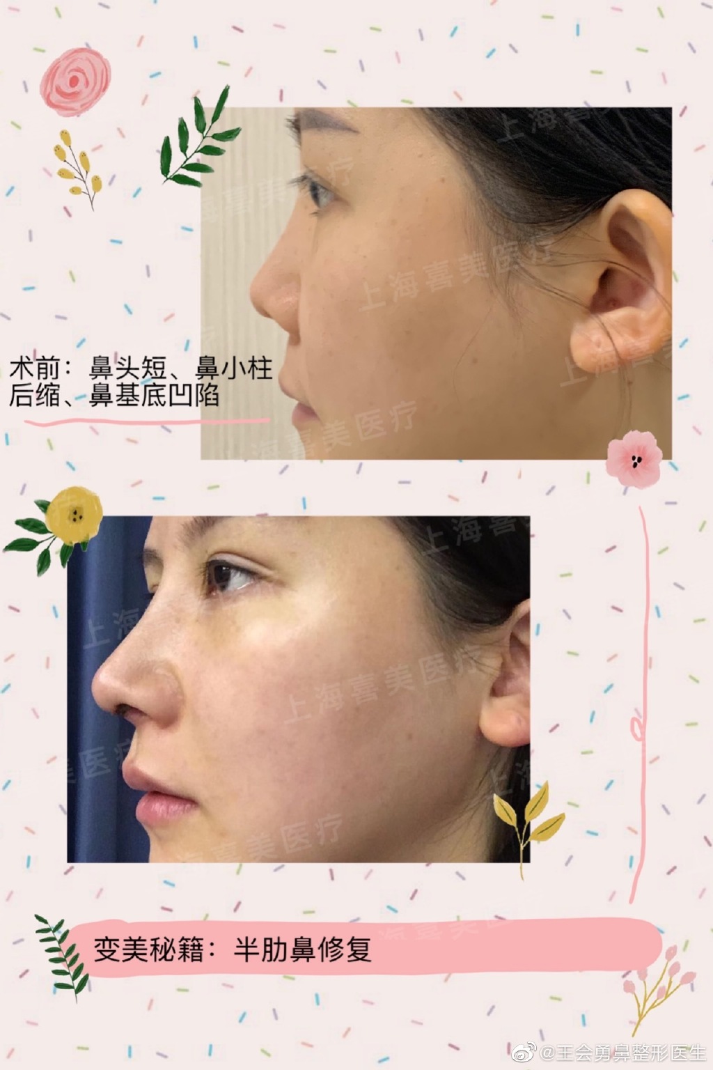 王會勇鼻修復案例