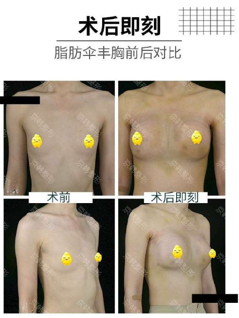 王沛森脂肪豐胸案例