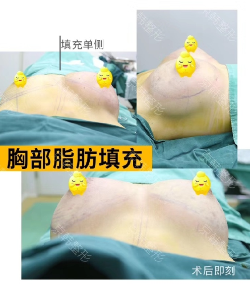 王沛森脂肪豐胸