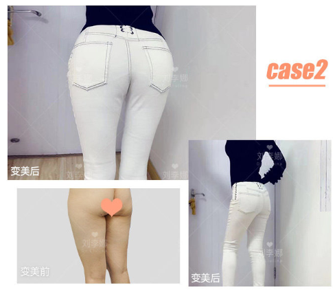 劉李娜豐臀案例