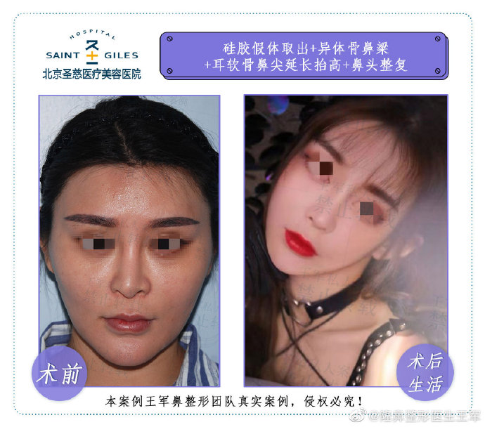 王軍隆鼻案例