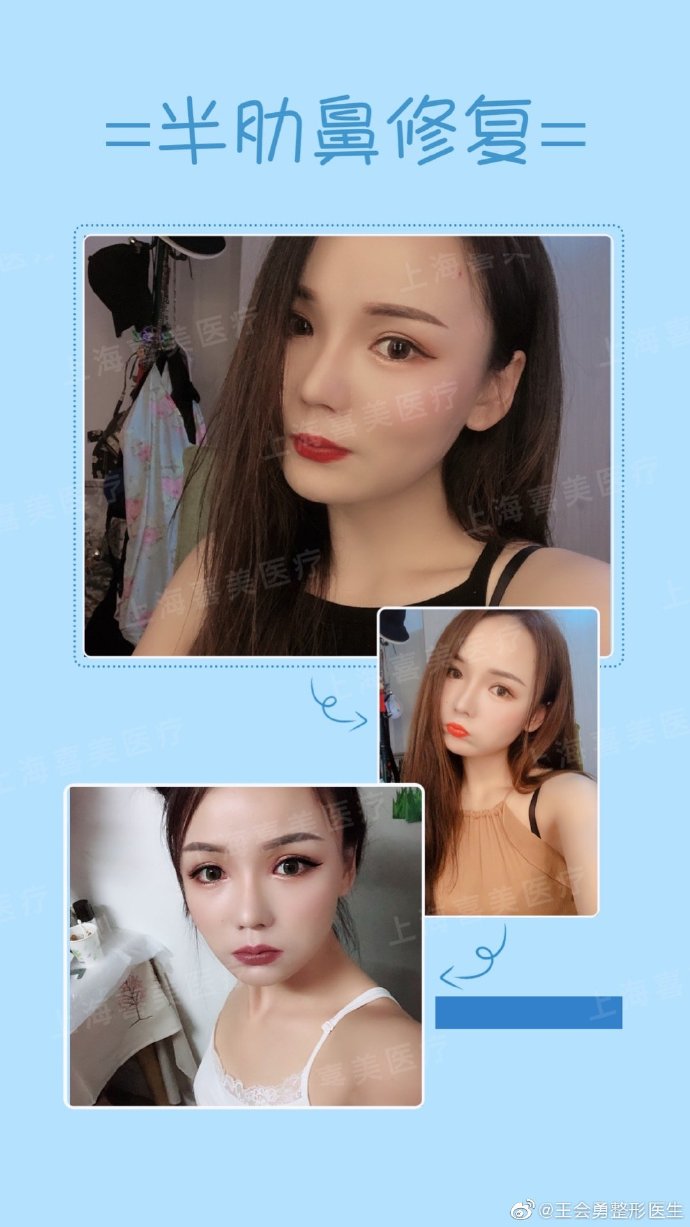 王會(huì)勇鼻案例