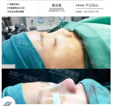 尹衛(wèi)民鼻修復(fù)案例