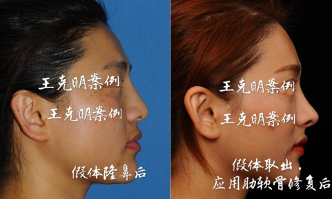 王克明鼻修復案例