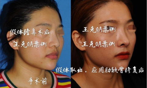 王克明鼻修復案例