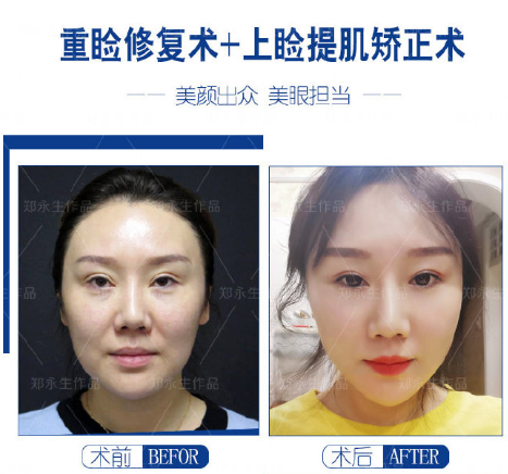 鄭永生眼修復(fù)案例