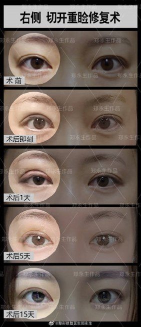 鄭永生眼修復(fù)案例