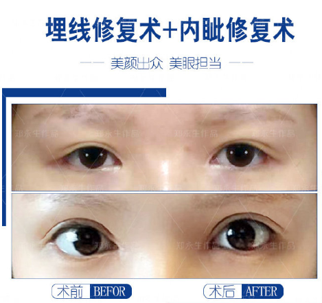 鄭永生雙眼皮修復(fù)案例