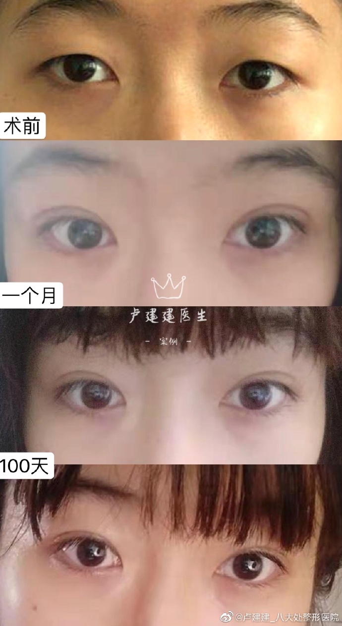 盧建建雙眼皮案例