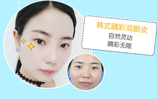上海九院雙眼皮專家排名