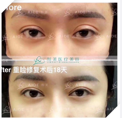 劉風(fēng)卓眼修復(fù)案例