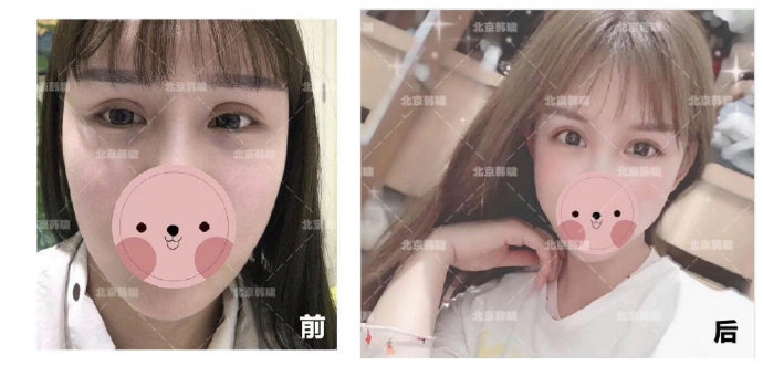 白永輝眼修復(fù)案例
