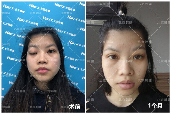 白永輝眼修復(fù)案例
