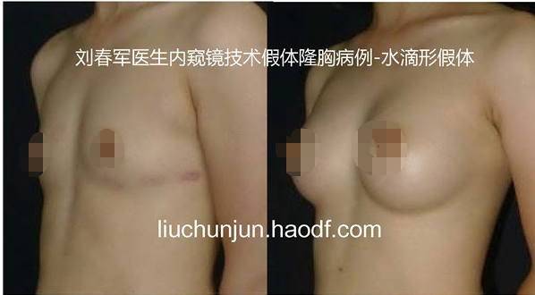 劉春軍豐胸案例