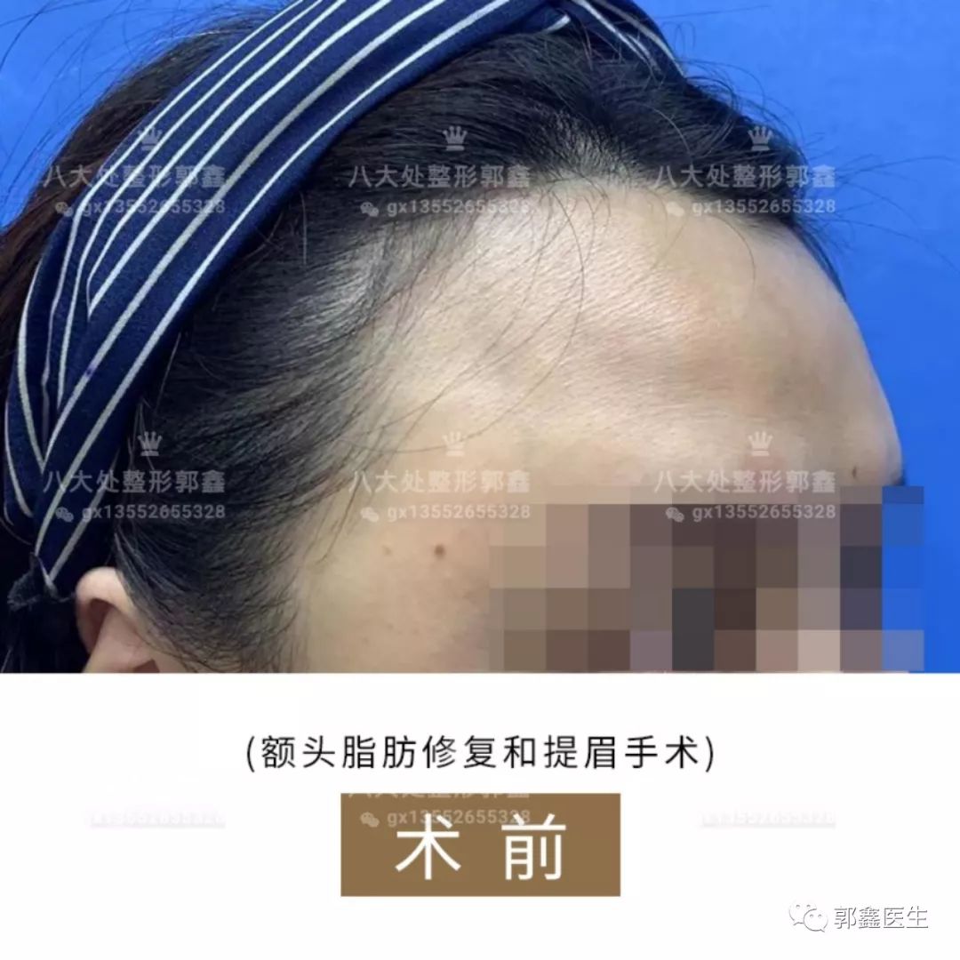 脂肪修復案例