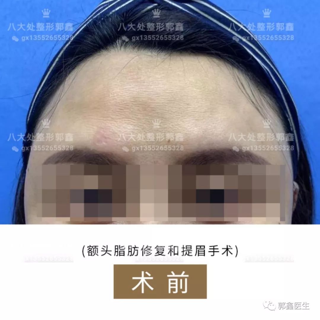 郭鑫脂肪修復案例