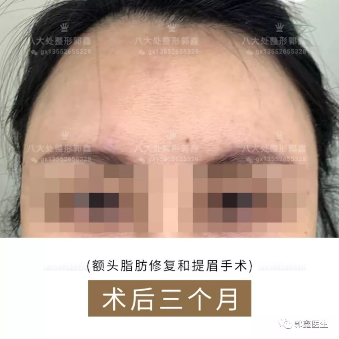 郭鑫脂肪修復案例