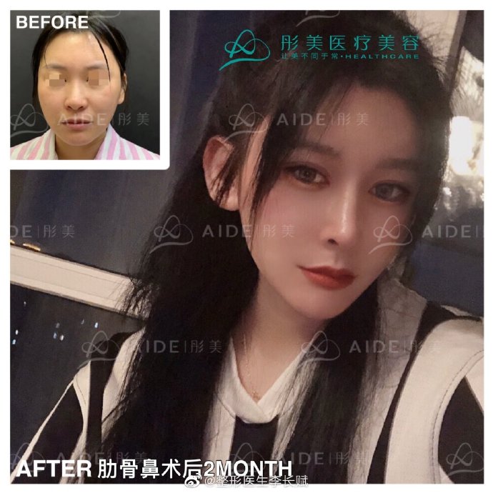 李長賦鼻綜合案例