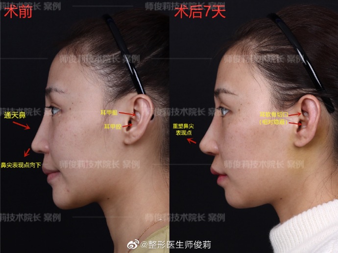 師俊莉鼻修復案例