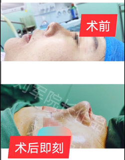 劉軍鼻修復案例