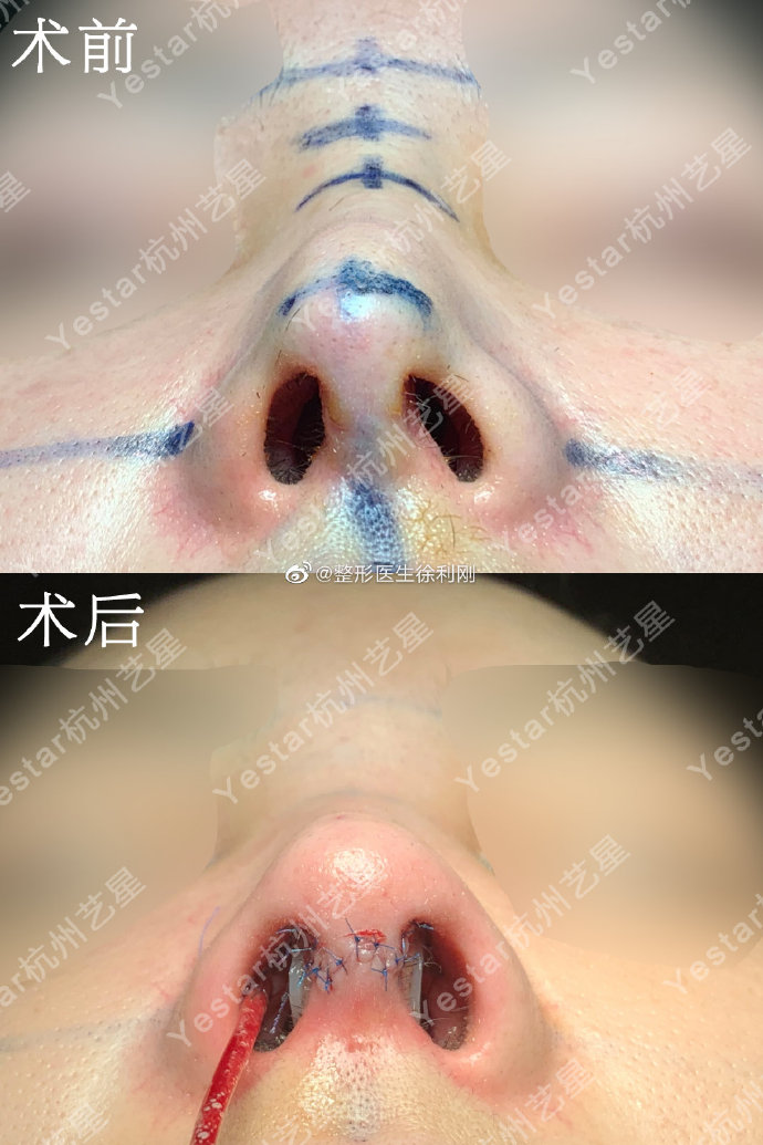 徐利剛鼻修復案例
