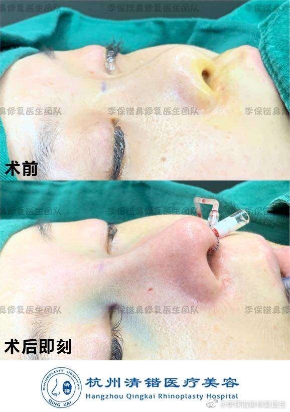 李保鍇鼻修復案例