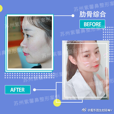 趙延峰鼻案例