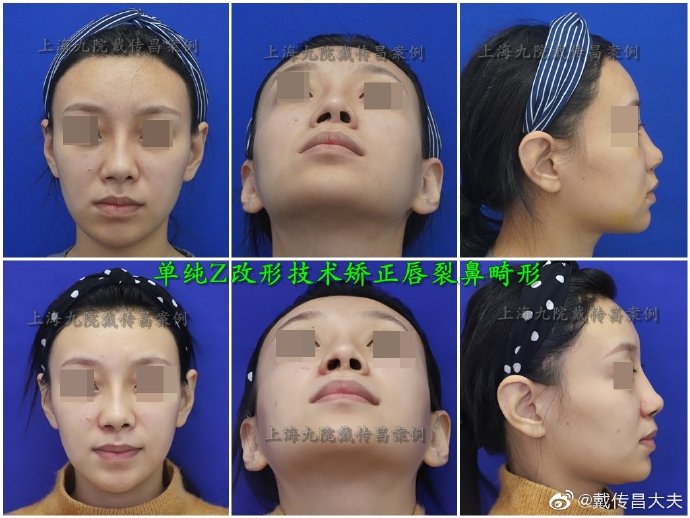 戴傳昌鼻修復(fù)案例