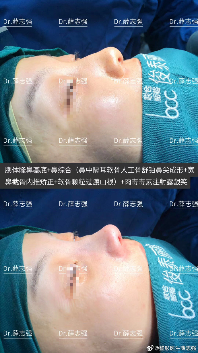薛志強鼻綜合案例