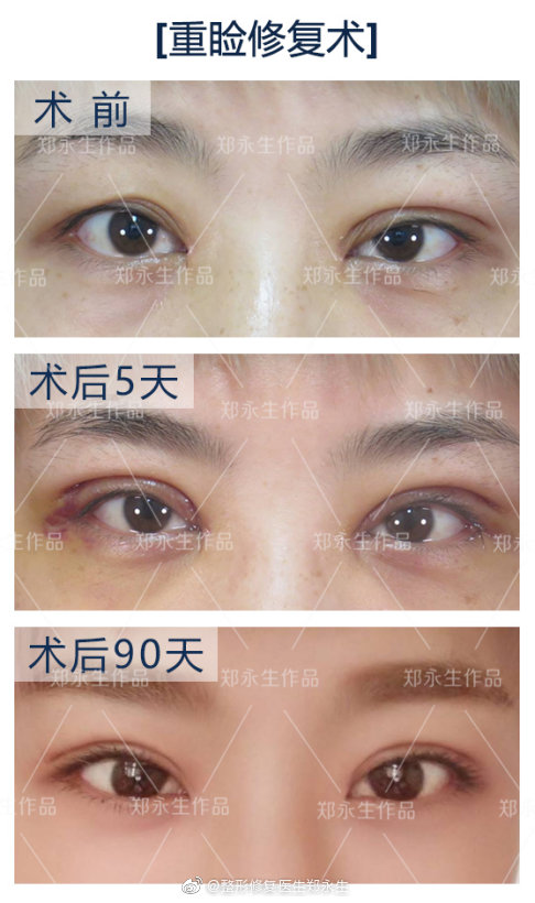 鄭永生雙眼皮修復案例