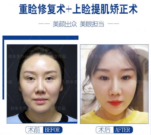 鄭永生雙眼皮修復案例