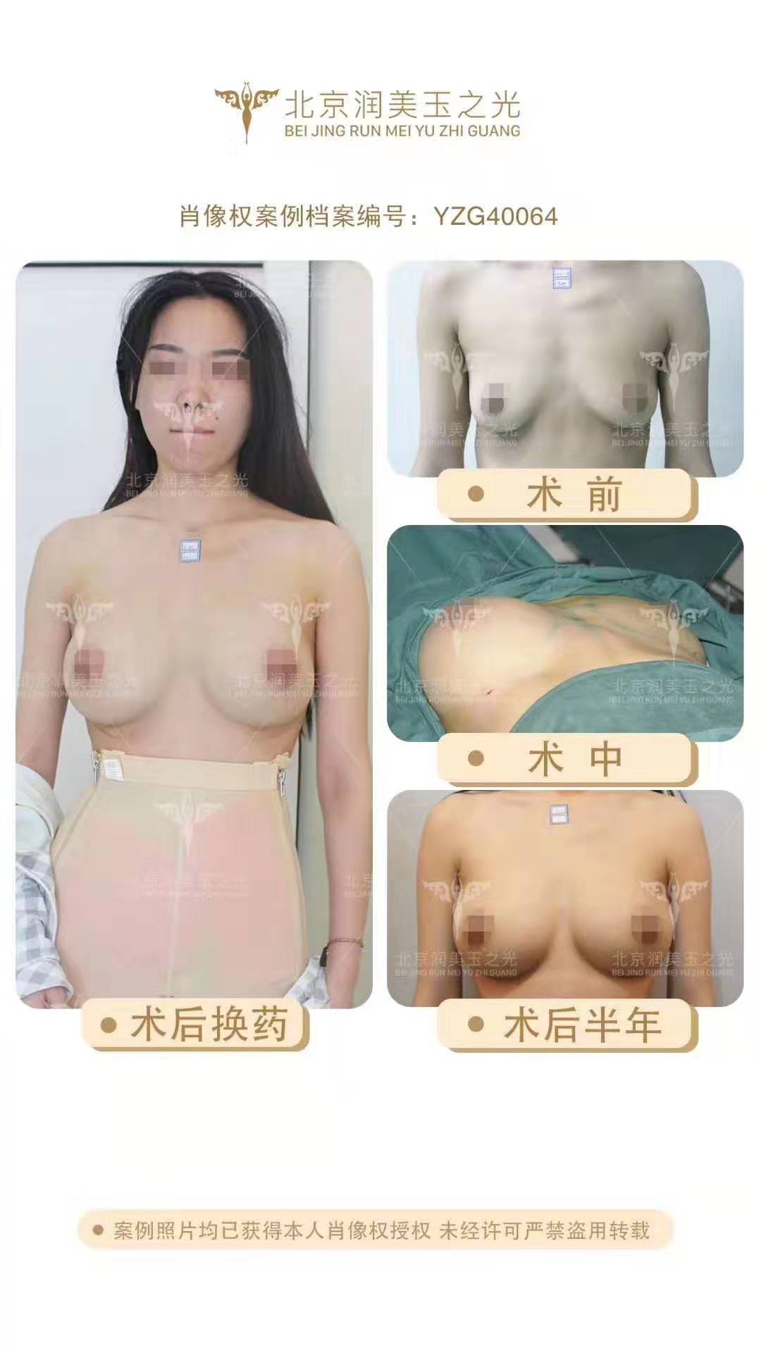 王明利脂肪豐胸案例