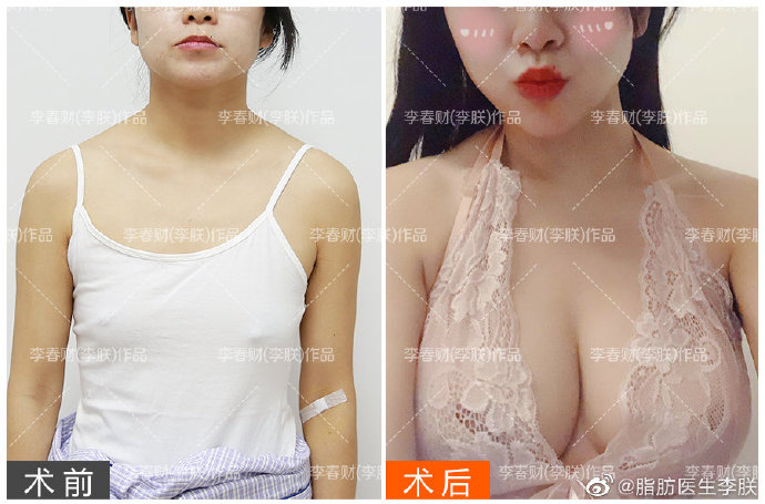 李朕脂肪豐胸案例
