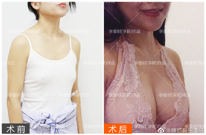 李朕脂肪豐胸案例