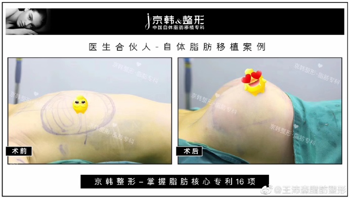 王沛森脂肪豐胸案例