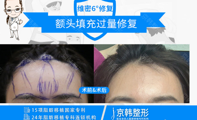 喬愛軍脂肪豐胸案例