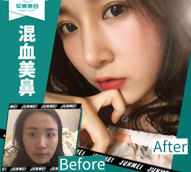 章一平鼻綜合案例