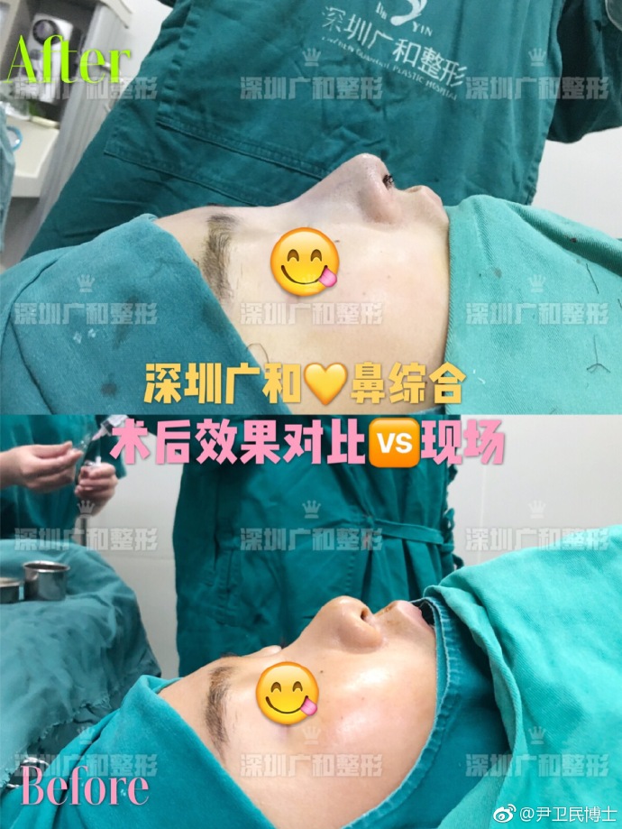 尹衛民鼻綜合案例